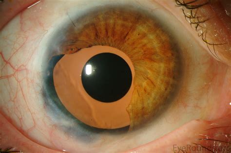 Atlas Entry - Ophtec 311 iris reconstruction intraocular lens after iris melanoma resection