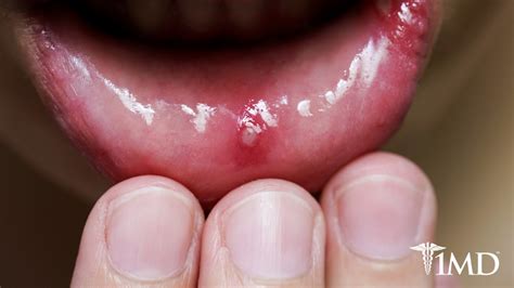 How to Tell if It's a Canker Sore, Cold Sore, or More Serious | 1MD