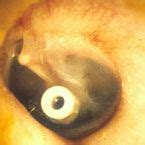 Grommet on ear drum after insertion | Grommets | Ear, Clinic, Human eye