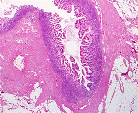 Meckel Diverticulum Histology