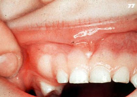 Odontoma Tumor - Types, Diagnosis, Histology, Treatment and Surgery