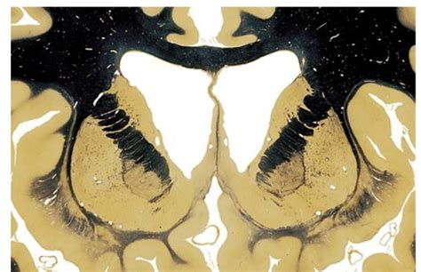 Ventral Striatum (Rostral Coronal View: anterior to thalamus) Diagram | Quizlet