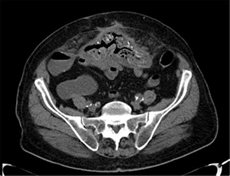 Preoperative CT scan demonstrating small bowel loops adherent to the mesh. | Download Scientific ...