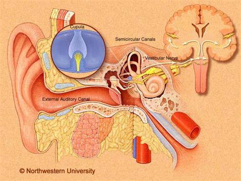 Vestibular neuritis (VN) and labyrinthitis