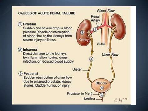 The Pathophysiology Of Acute Renal Failure