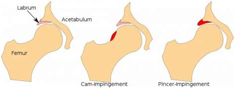 FAI: All About Femoral Acetabulum Impingement - Markow Training Systems