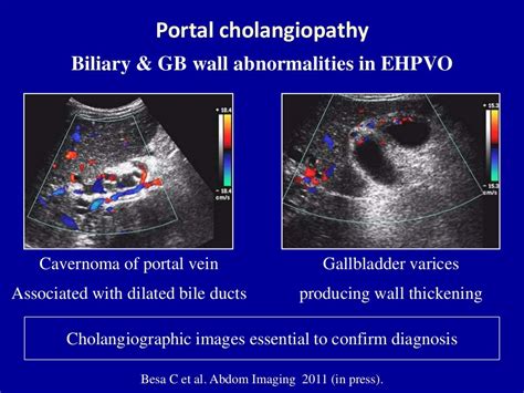 Doppler ultrasound of portal vein thrombosis