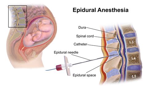 Difference Between Spinal and Epidural Anesthesia | Purpose, Procedure, Effect, Risks