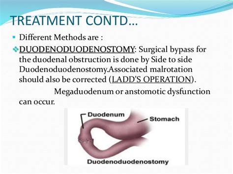 duodenal atresia