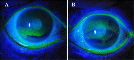 Case 1. Anterior segment photography. Superficial punctate... | Download Scientific Diagram