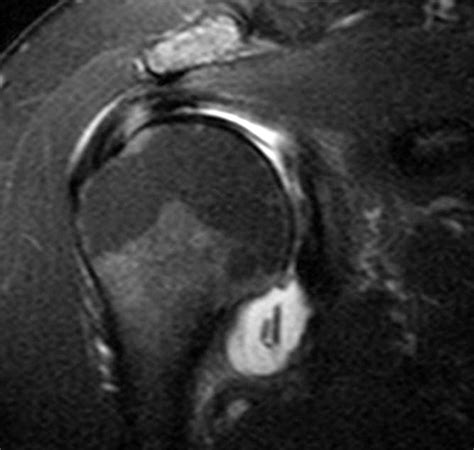 Chondrolysis of the Glenohumeral Joint | Radsource