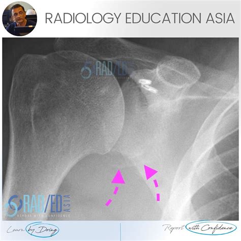 SHOULDER DISLOCATION BONY BANKART GLENOID FRACTURE XRAY CT (VIDEO) - Radedasia