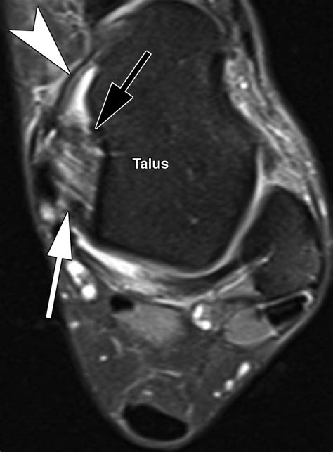 MRI and Surgical Findings in Deltoid Ligament Tears | AJR