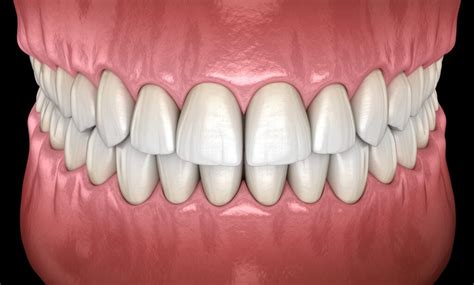 How Does My Bite Classification Impact My Orthodontic Treatment? - Love Brushing Dentistry