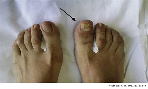 Psoriatic Arthritis Toes