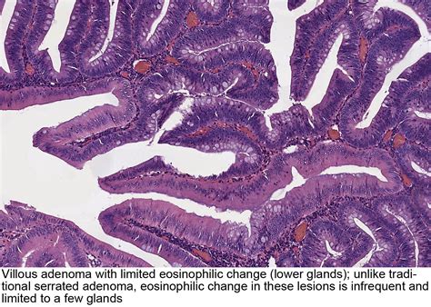 Pathology Outlines - Tubulovillous / villous adenoma