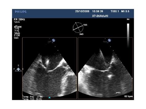 Mitraclip procedure A to Z