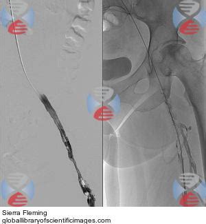 INARI Thrombectomy: Before | Global Library of Scientific Images