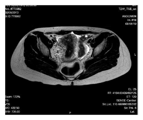 MRI: T2-weighted imaging. (a) Coronal view. (b) Axial view: uterus with... | Download Scientific ...