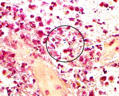 Listeria Monocytogenes Gram Stain | My XXX Hot Girl