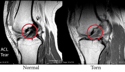 Garrett Berry News: Acl Tear Mri Vs Normal