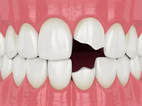 How To Fix A Broken Tooth Berwick VIC | 7 Helpful Ways | 03 9702 0234