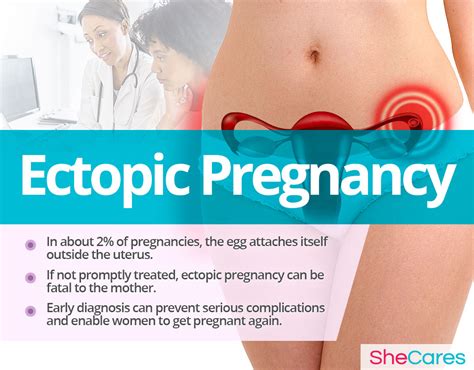 Ectopic Pregnancy | SheCares