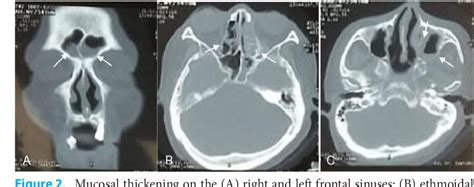 A rare nasal myiasis in a patient with diabetes mellitus | Semantic Scholar