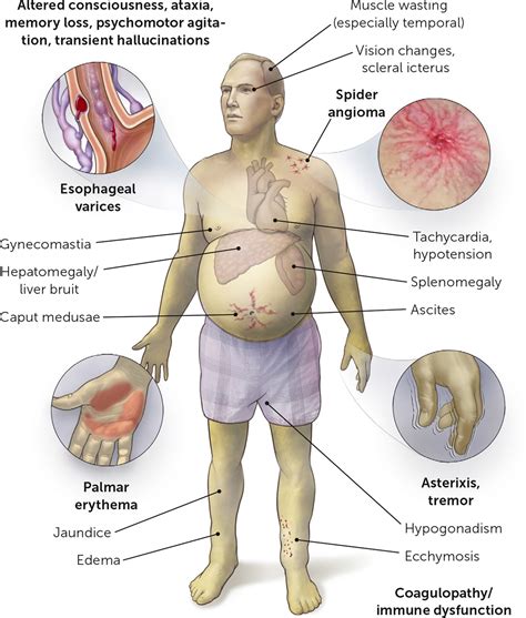 Alcoholic Hepatitis: Diagnosis and Management | AAFP