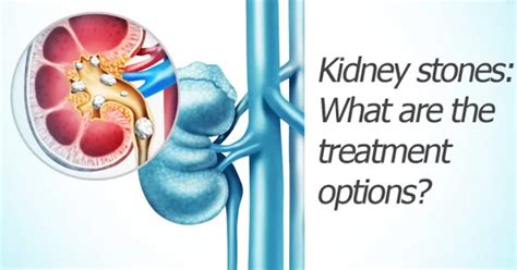 Kidney stones: What are the treatment options? | Advanced Urology Institute