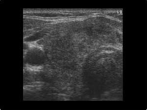 Head and Neck | 4.1 Thyroid gland : Case 4.1.4 Thyroiditis and diffuse thyroid disease ...