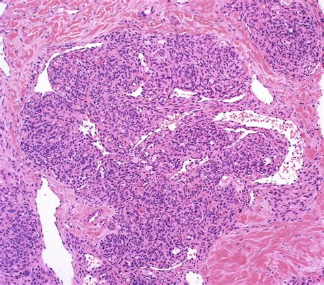 Figure 6 from Histopathology of Spindle Cell Vascular Tumors. | Semantic Scholar