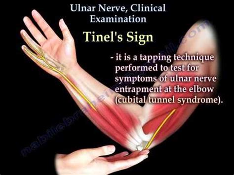 Ulnar Nerve Entrapment Test