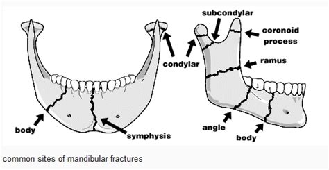 hiphoplife: mandible fracture