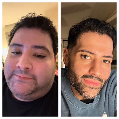 20 months post op. Side profile and frontal before and after. 350-160 ...