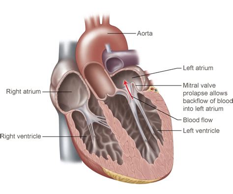 Mitral Valve Prolapse | Temple Health