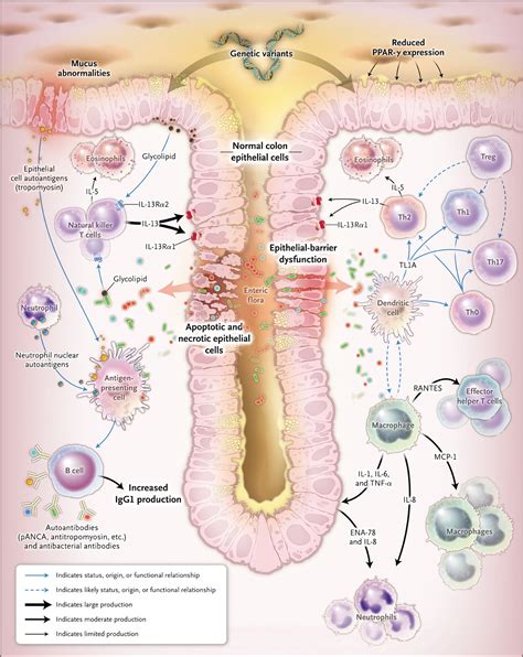 Ulcerative Colitis | NEJM