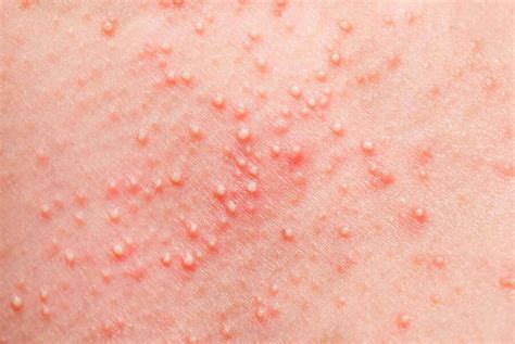 Miliaria or Sweat Rash in Infants: What Is It? - You are Mom