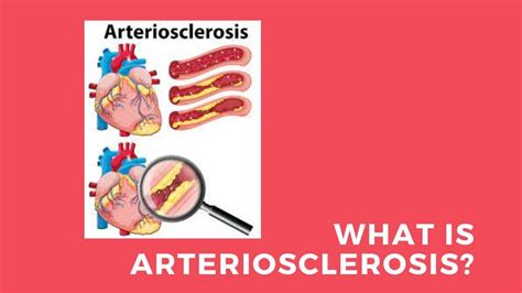 What Is Arteriosclerosis - Signs, Causes, Symptoms, And How To Treat » 2024