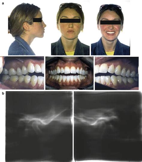 Idiopathic/Progressive Condylar Resorption: An Orthodontic Perspective | Pocket Dentistry