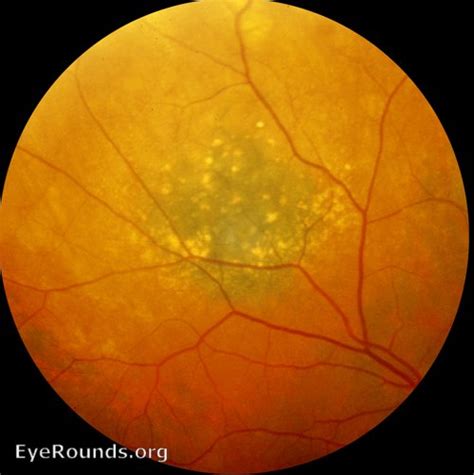 Atlas Entry - Choroidal Nevus