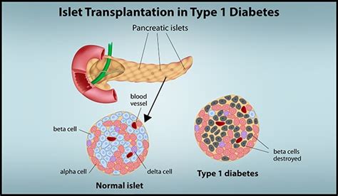 Islet Transplantation Improves Quality of Life for People with Hard-to-control Type 1 Diabetes ...