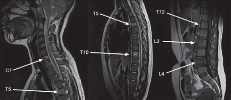 MRI scan of whole spine revealed multiple lytic lesions are seen at... | Download Scientific Diagram