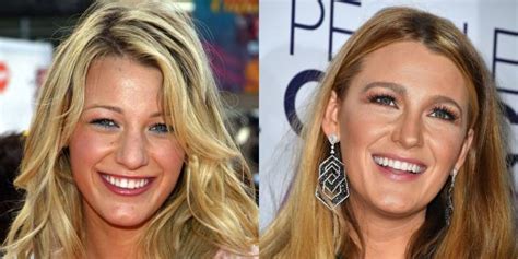 These 10 Celebrity Smile Transformations Will Astound You