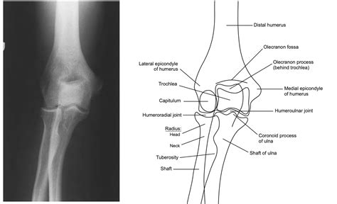 Elbow Anatomy Xray