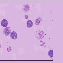 (PDF) Azurophilic inclusions in plasma cells