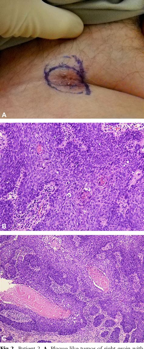 Figure 2 from Basaloid squamous cell carcinoma of the skin. | Semantic Scholar