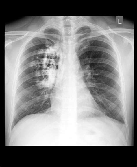 Lung Cancer | Lung Cancer Symptoms | MedlinePlus