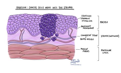 Squamous cell carcinoma of the oral cavity | MyPathologyReport.ca