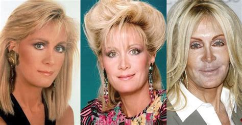 Joan Van Ark Plastic Surgery Before and After Pictures 2024